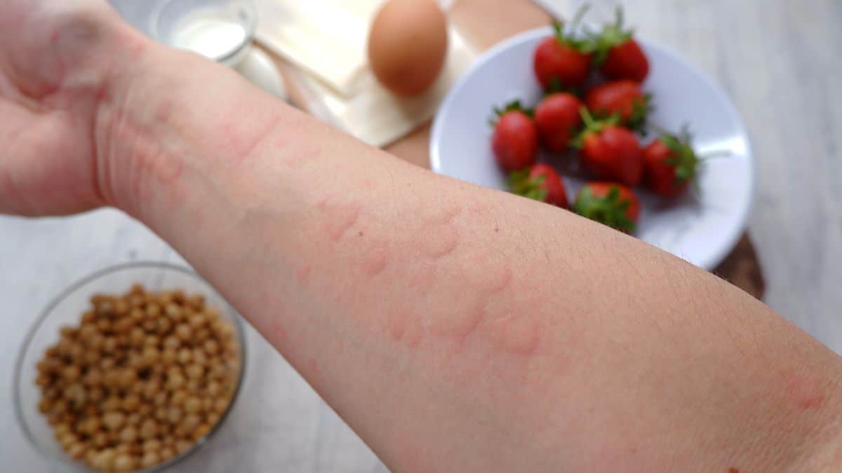 Alergic symptoms on forearm, in background table with strawberries, nuts and eg